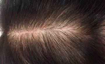 Мезотерапия волосистой части головы, работа Радионовой Марии - фото до