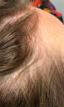 Фракционная мезотерапия волосистой части головы, работа Радионовой Марии - фото до