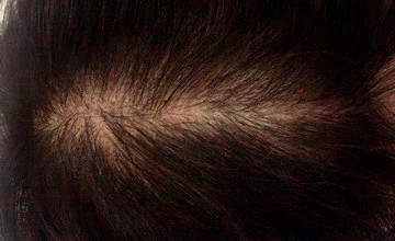 Мезотерапия волосистой части головы, работа Радионовой Марии - фото после