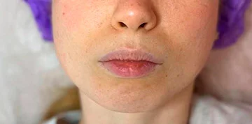Аугментация губ, Belotero Lips Contour (Швейцария), работа Радионовой Марии - фото до