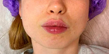 Аугментация губ, Belotero Lips Contour (Швейцария), работа Радионовой Марии - фото после